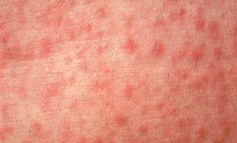 EPIDEMIJA_1207294836.jpg Foto: HRT
